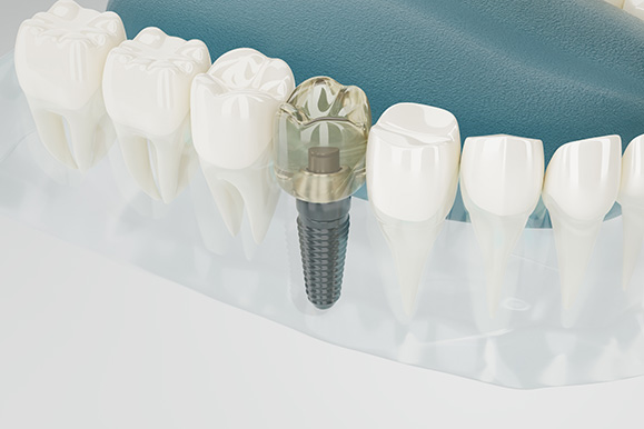 Focus Dental Bodrum İmplant Diş Tedavileri