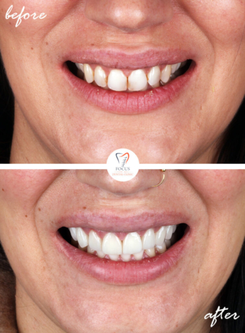 Focus Dental Clinic Bodrum Turkey Before After