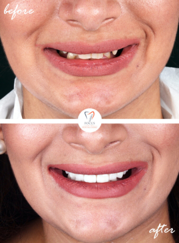 Focus Dental Clinic Bodrum Turkey Before After