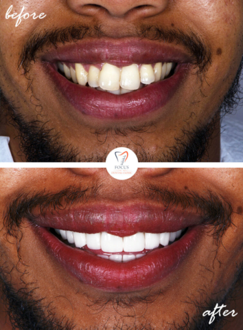 Focus Dental Clinic Bodrum Turkey Before After