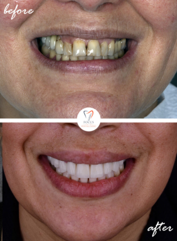 Focus Dental Clinic Bodrum Turkey Before After