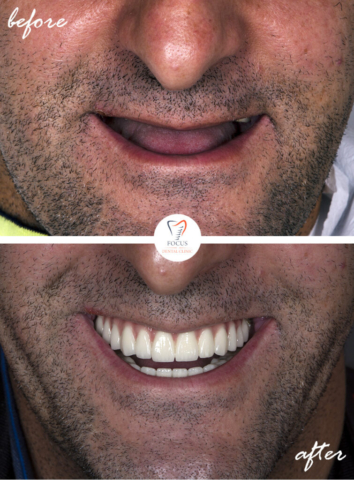 Focus Dental Clinic Bodrum Turkey Before After