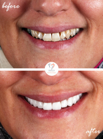 Focus Dental Clinic Bodrum Turkey Before After