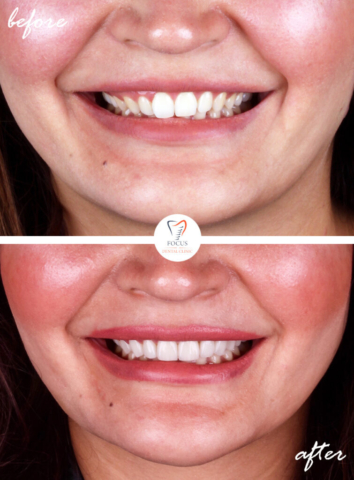 Focus Dental Clinic Bodrum Turkey Before After