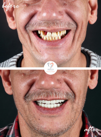Focus Dental Clinic Bodrum Turkey Before After