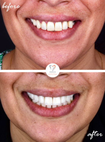 Focus Dental Clinic Bodrum Turkey Before After