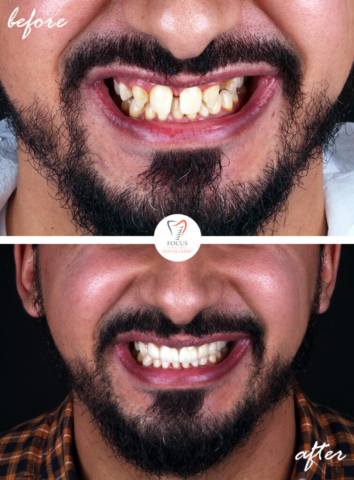 Focus Dental Clinic Bodrum Turkey Before After