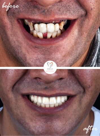 Focus Dental Clinic Bodrum Turkey Before After