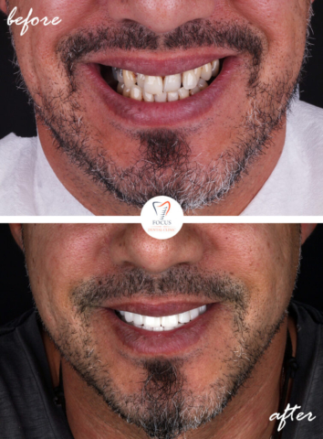 Focus Dental Clinic Bodrum Turkey Before After
