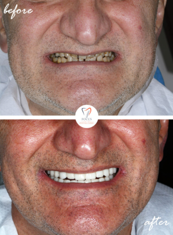 Focus Dental Clinic Bodrum Turkey Before After