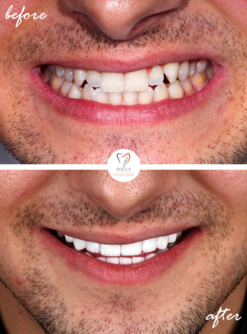 Focus Dental Clinic Bodrum Turkey Before After