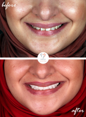 Focus Dental Clinic Bodrum Turkey Before After