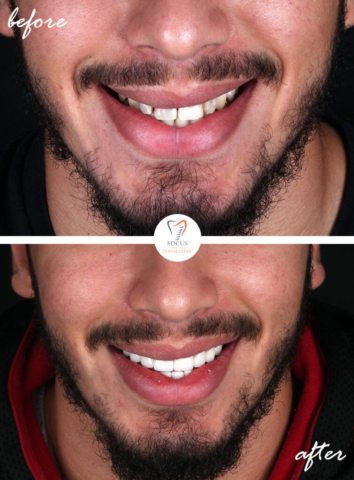 Focus Dental Clinic Bodrum Turkey Before After