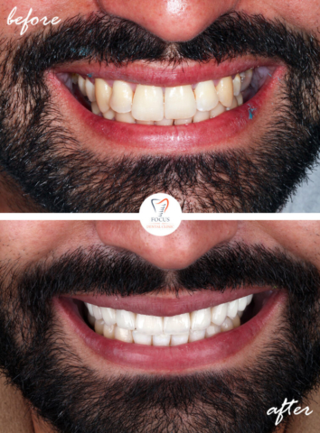 Focus Dental Clinic Bodrum Turkey Before After