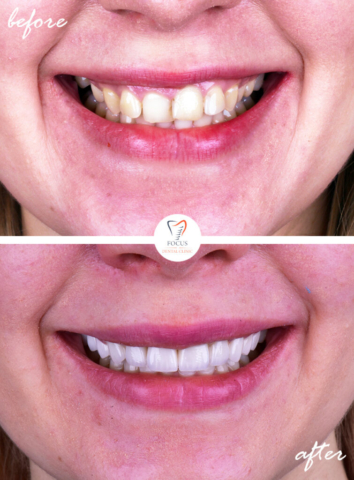 Focus Dental Clinic Bodrum Turkey Before After