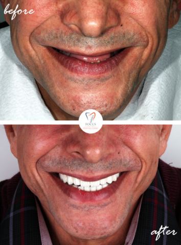 Focus Dental Clinic Bodrum Turkey Before After