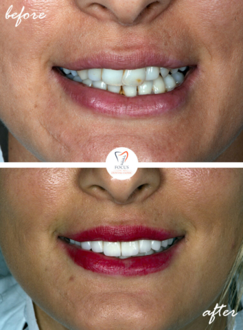 Focus Dental Clinic Bodrum Turkey Before After