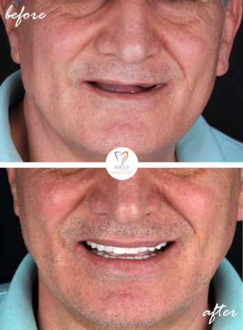 Focus Dental Clinic Bodrum Turkey Before After