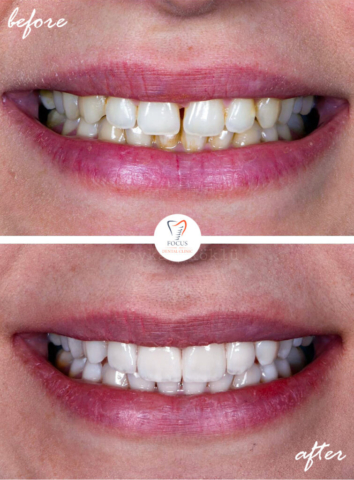 Focus Dental Clinic Bodrum Turkey Before After