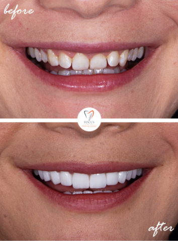 Focus Dental Clinic Bodrum Turkey Before After