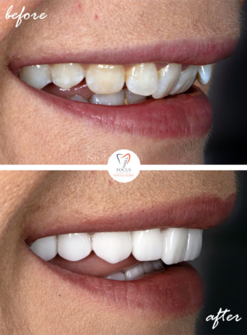 Focus Dental Clinic Bodrum Turkey Before After