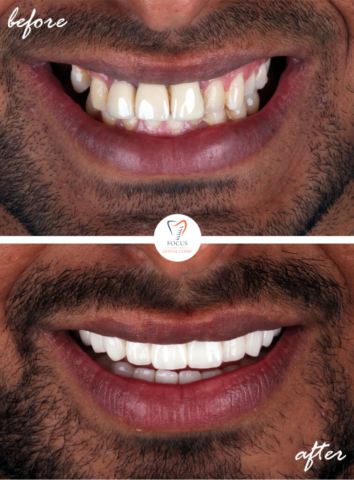Focus Dental Clinic Bodrum Turkey Before After