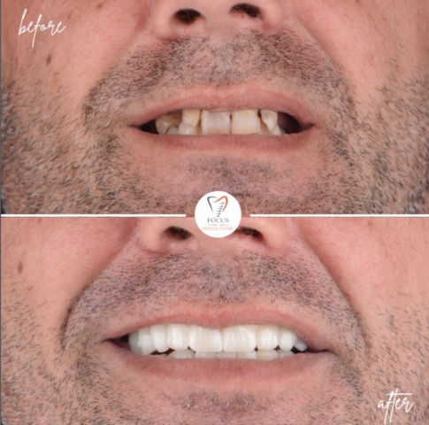 Focus Dental Clinic Bodrum All on 4 Before After