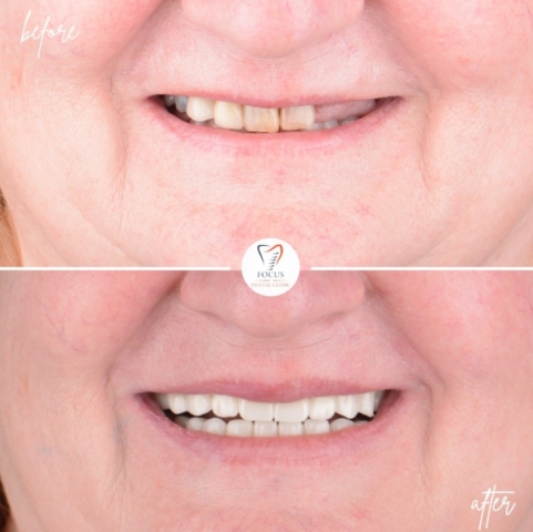 Focus Dental Clinic Bodrum All on 4 Before After
