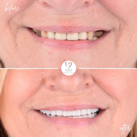 Focus Dental Clinic Bodrum All on 4 Before After