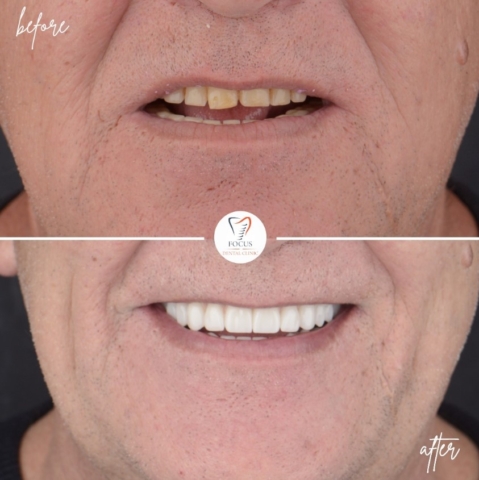 Focus Dental Clinic Bodrum All on 4 Before After