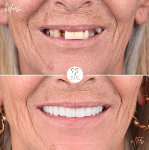 Focus Dental Clinic Bodrum All on 4 Before After