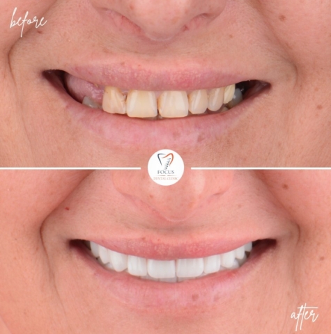 Focus Dental Clinic Bodrum All on 4 Before After