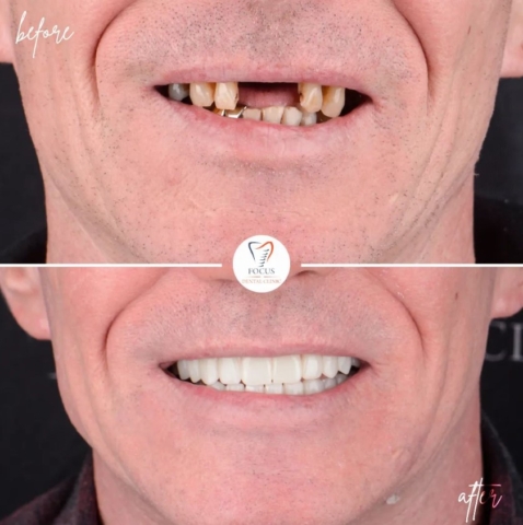 Focus Dental Clinic Bodrum All on 4 Before After