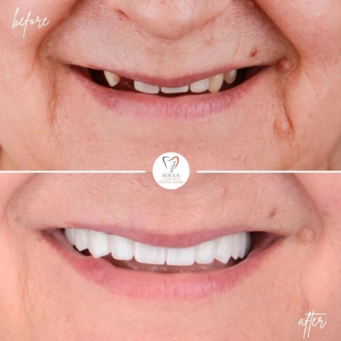 Focus Dental Clinic Bodrum All on 4 Before After