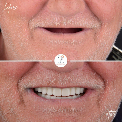 Focus Dental Clinic Bodrum All on 4 Before After
