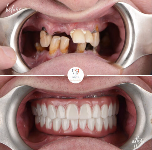 Focus Dental Clinic Bodrum All on 4 Before After
