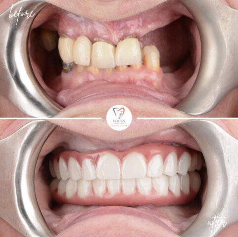 Focus Dental Clinic Bodrum All on 4 Before After