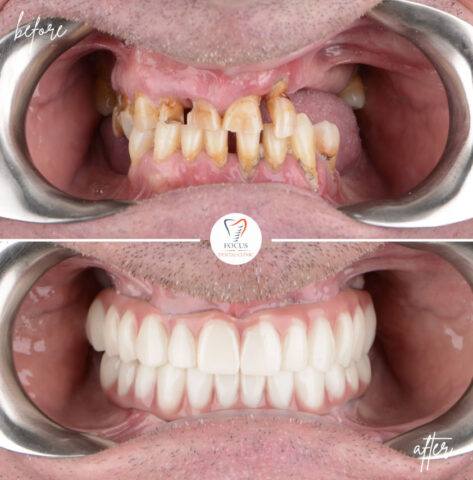 Focus Dental Clinic Bodrum All on 4 Before After