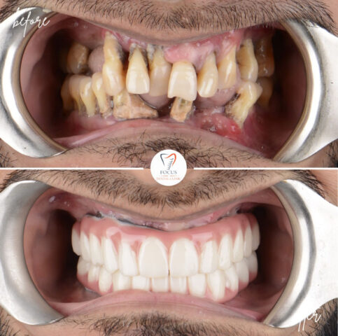Focus Dental Clinic Bodrum All on 4 Before After