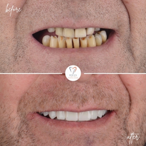 Focus Dental Clinic Bodrum All on 6 Before After