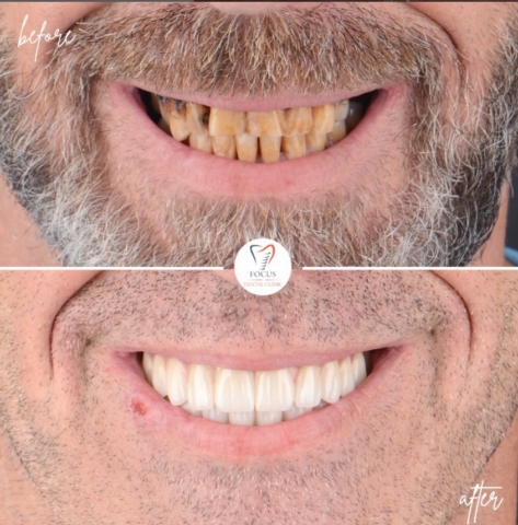 Focus Dental Clinic Bodrum All on 6 Before After