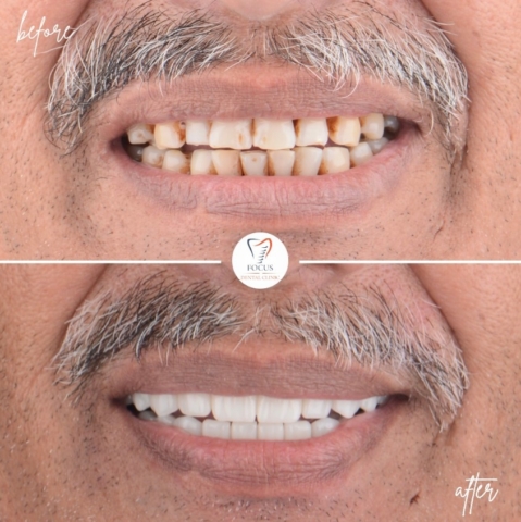Focus Dental Clinic Bodrum All on 6 Before After