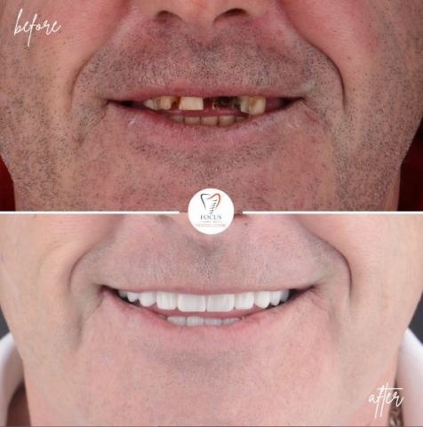 Focus Dental Clinic Bodrum All on 6 Before After