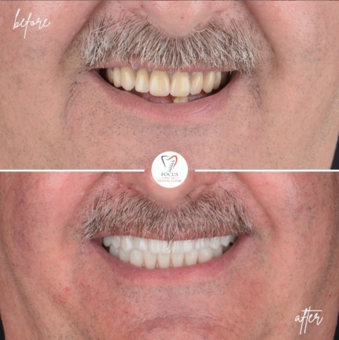 Focus Dental Clinic Bodrum All on 6 Before After
