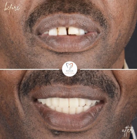 Focus Dental Clinic Bodrum All on 6 Before After