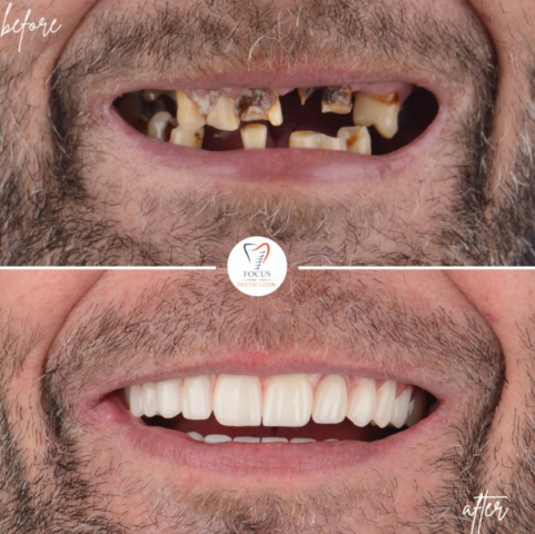 Focus Dental Clinic Bodrum All on 6 Before After