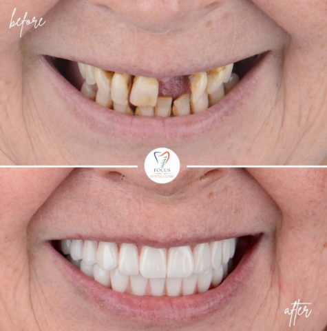 Focus Dental Clinic Bodrum All on 6 Before After