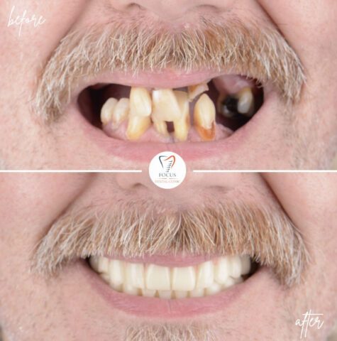 Focus Dental Clinic Bodrum All on 6 Before After