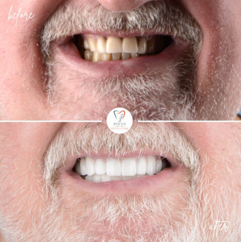 Focus Dental Clinic Bodrum All on 6 Before After