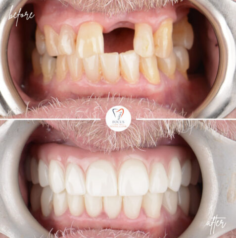 Focus Dental Clinic Bodrum All on 6 Before After